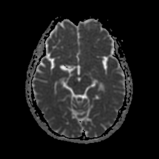 MRI ADC Map