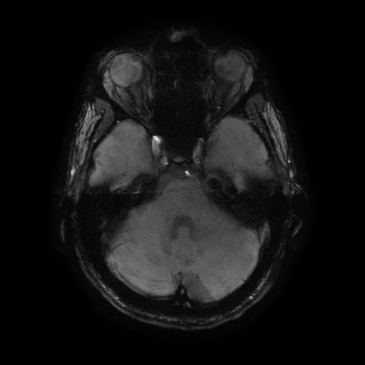 MRI Axial SWI SWAN