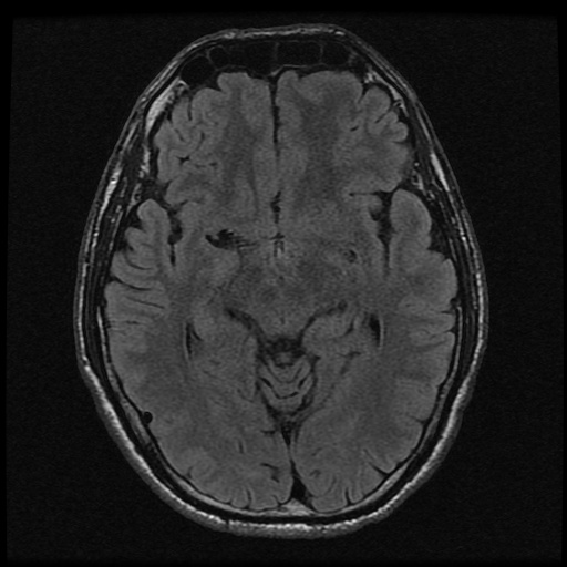 MRI Axial T2 FLAIR