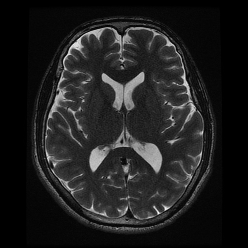 MRI Axial T2 FRFSE