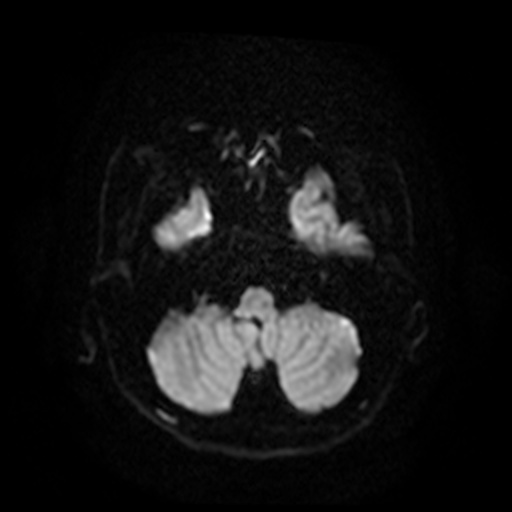 MRI Brain Axial DWI Slice 30