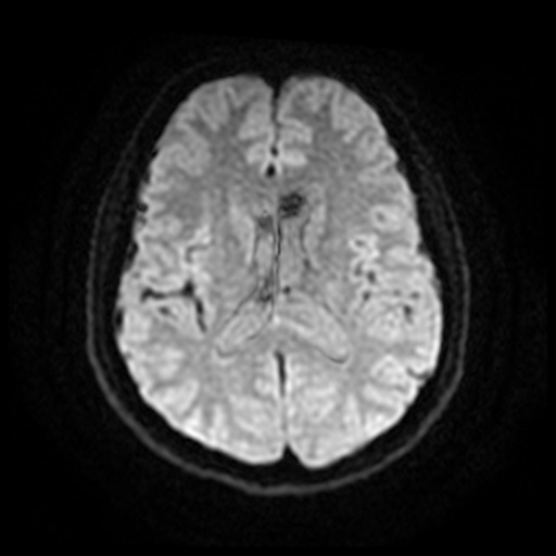 MRI Brain Axial DWI Slice 50