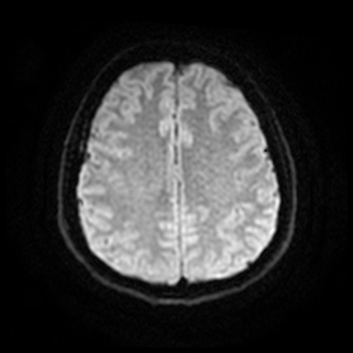 MRI Brain Axial DWI Slice 56