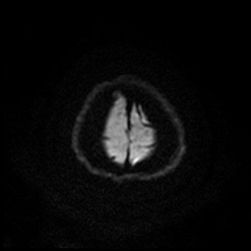 MRI Brain Axial DWI Slice 70