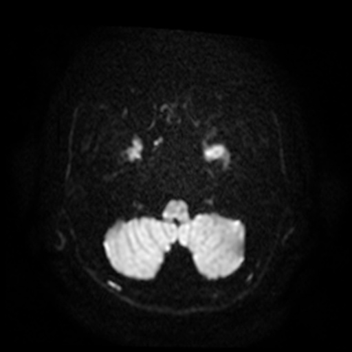 MRI Brain Axial DWI Slice 80