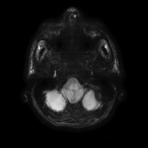 MRI SWAN MinIP